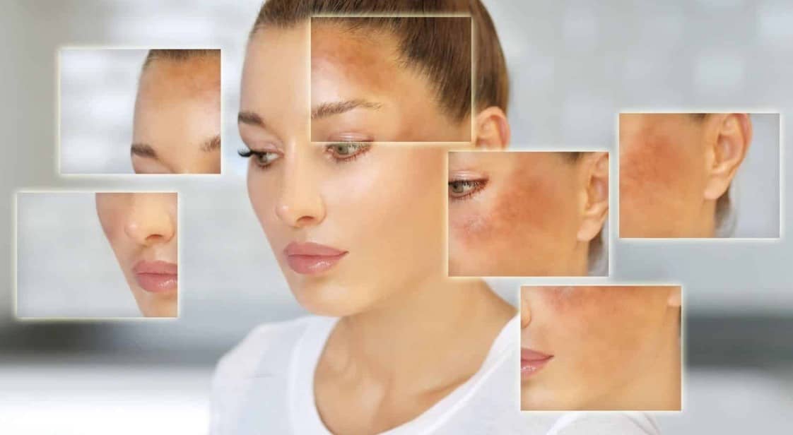 ¿Por qué salen manchas en la cara? 3 causas que no tienen que ver con el sol