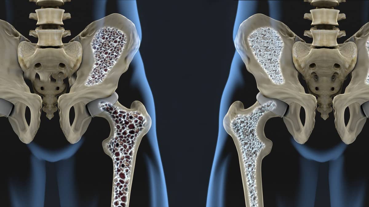 Estos son los factores que aumentan el riesgo de sufrir osteoporosis