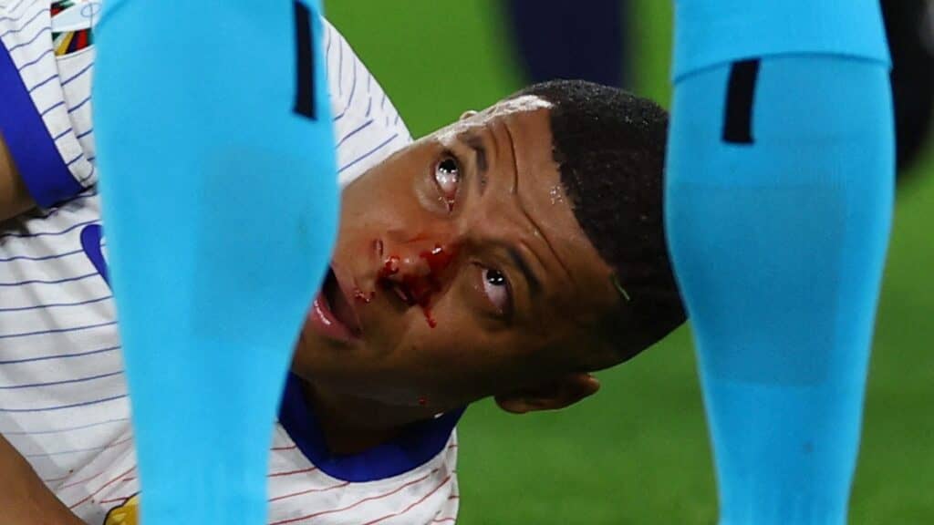 Kylian Mbappé se fractura la nariz; así fue el momento del accidente en partido Francia vs Austria