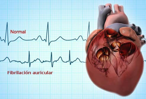 Estrés laboral puede aumentar riesgo de sufrir fibrilación auricular