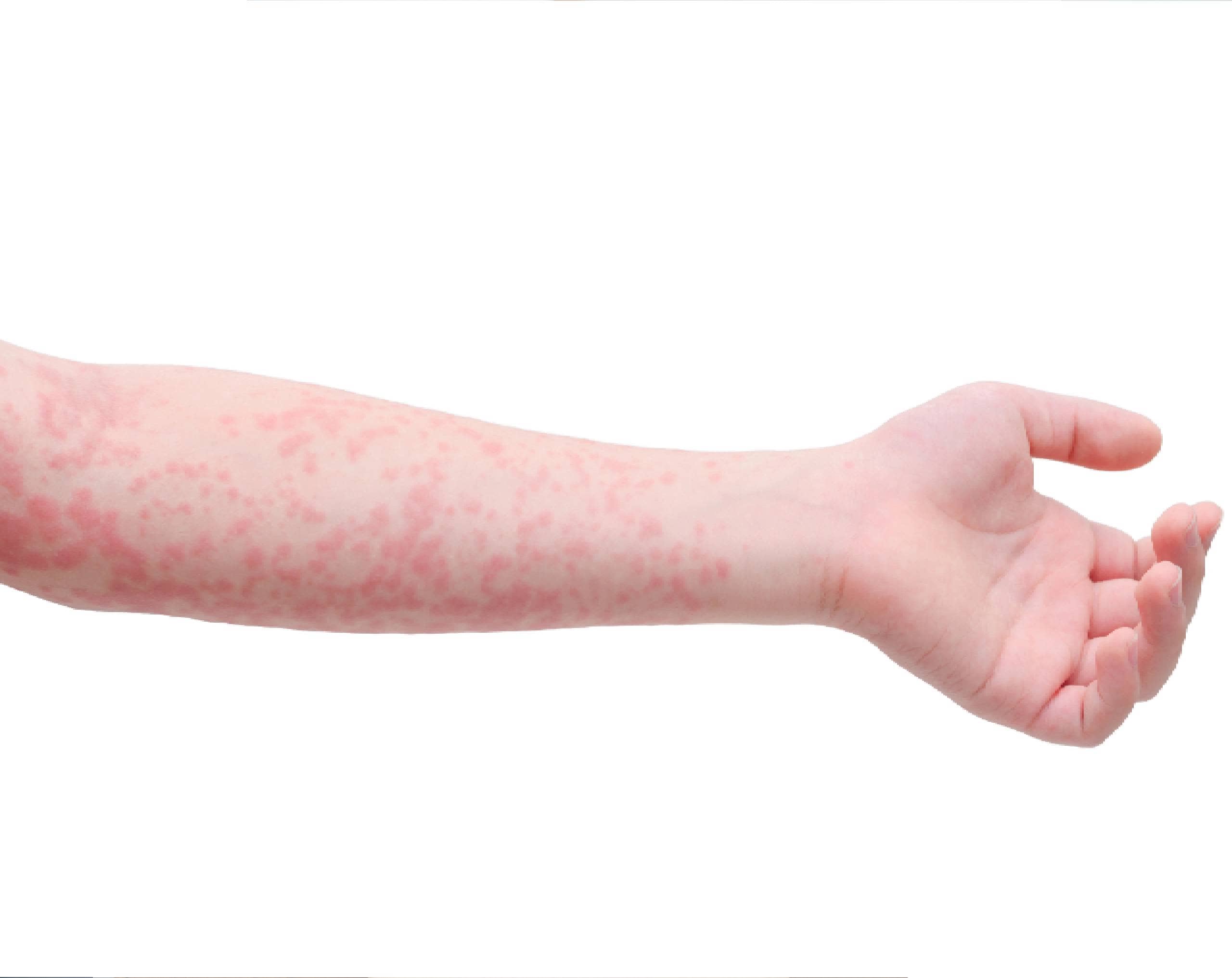 México rebasa los cinco mil casos de sarampión