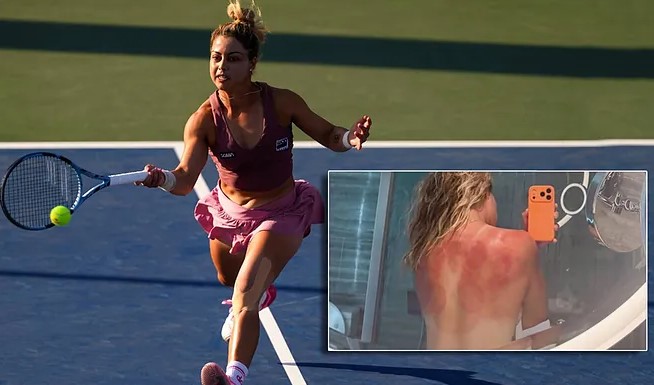 Renata Zarazúa desnuda su espalda para alertar del peligro en Australia